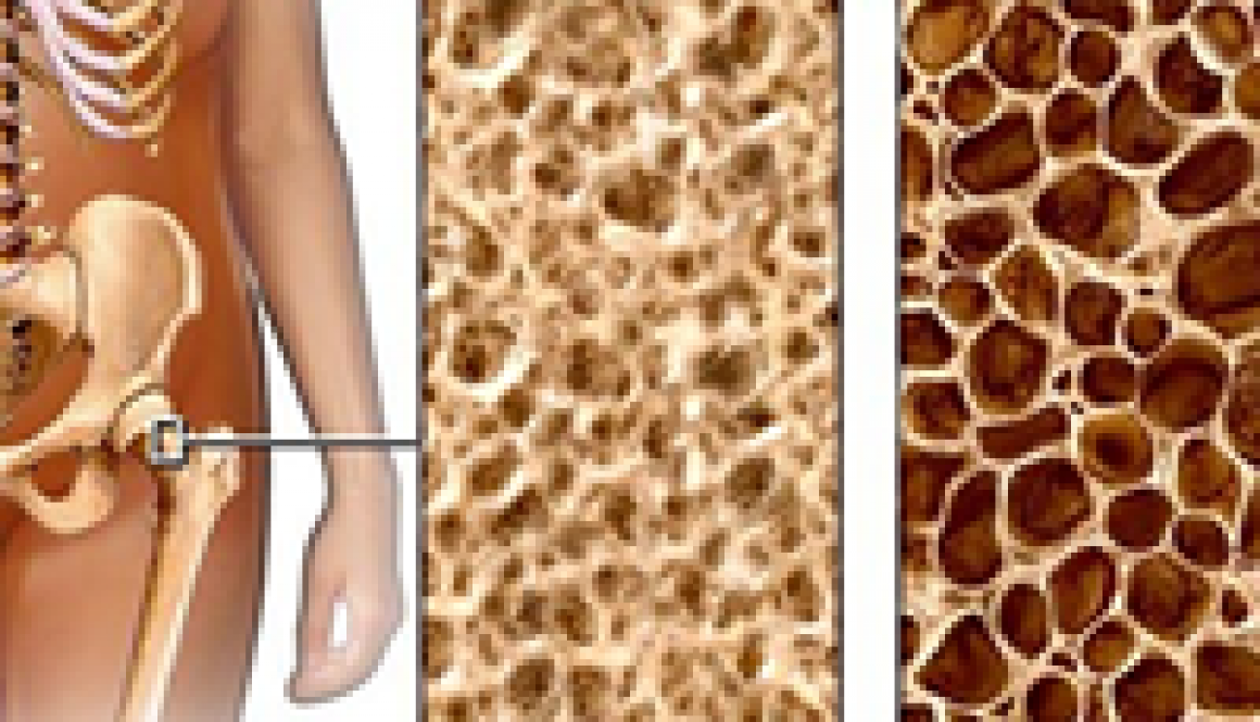 img destacada ostoporose post img destacada ostoporose post