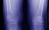 osteoartrite 2